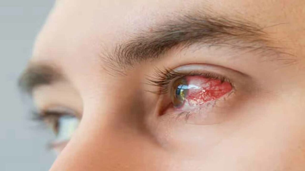 Splinter Eye Infection How to Protect Yourself from the Pink Eye Infection Outbreak