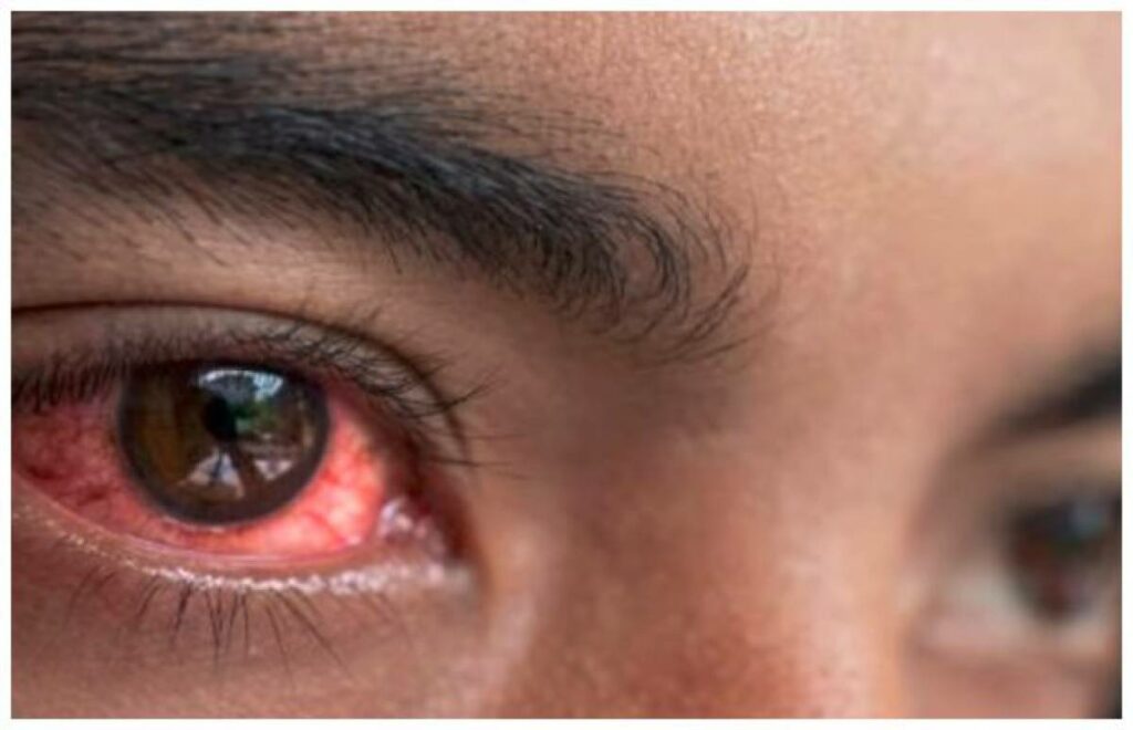 Eye Infection in Pakistan: Schools in Punjab to Be Closed From Tomorrow Through Monday