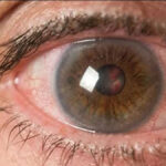 Single Non-Surgical Treatment for Corneal Disease Shows Benefits for 3 Years