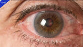 Single Non-Surgical Treatment for Corneal Disease Shows Benefits for 3 Years