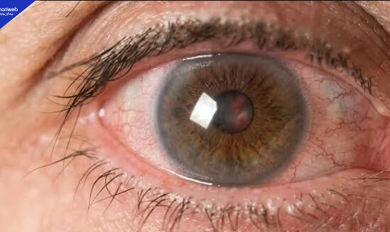 Single Non-Surgical Treatment for Corneal Disease Shows Benefits for 3 Years
