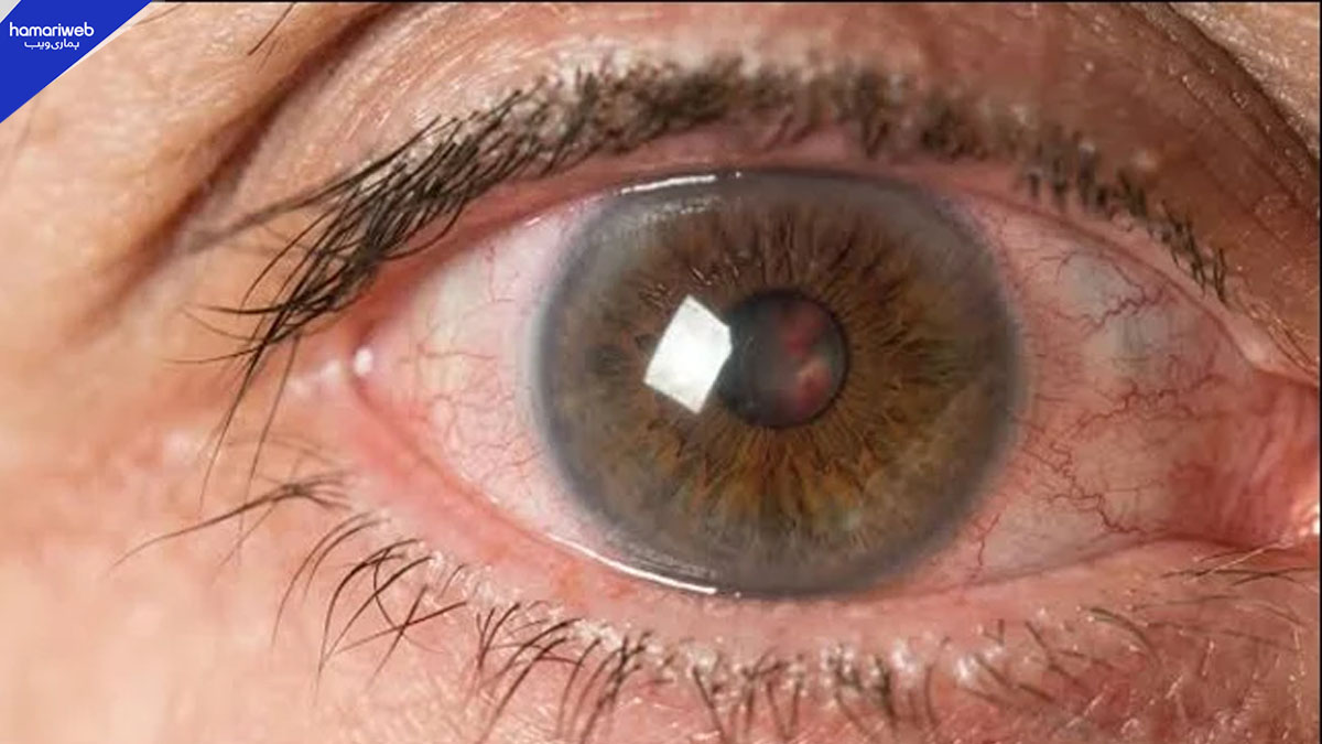 Single Non-Surgical Treatment for Corneal Disease Shows Benefits for 3 Years